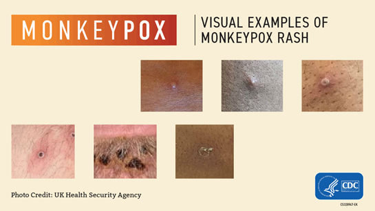 MONKEYPOX / Visual examples of Monkeypox rash - Photo credit: UK Health Security Agency - CDC logo in bottom of image.