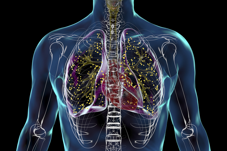 Image of an xray of a chest with tuberculosis